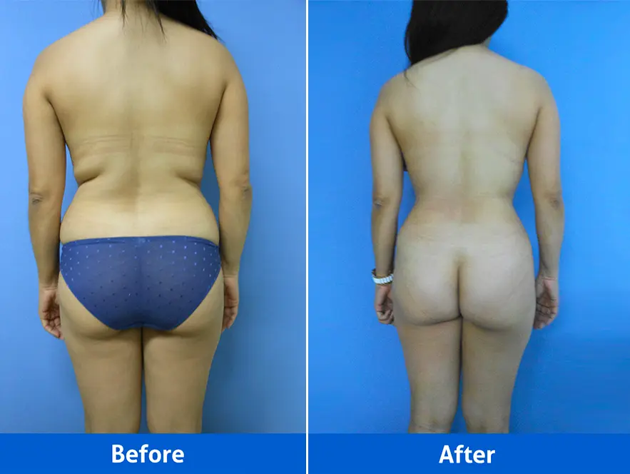 Rhinoplasty before and after front view, Patient 4