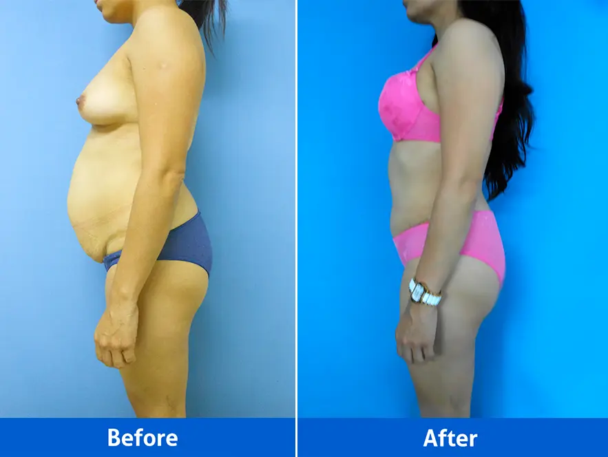 Rhinoplasty before after photos right profile patient 3