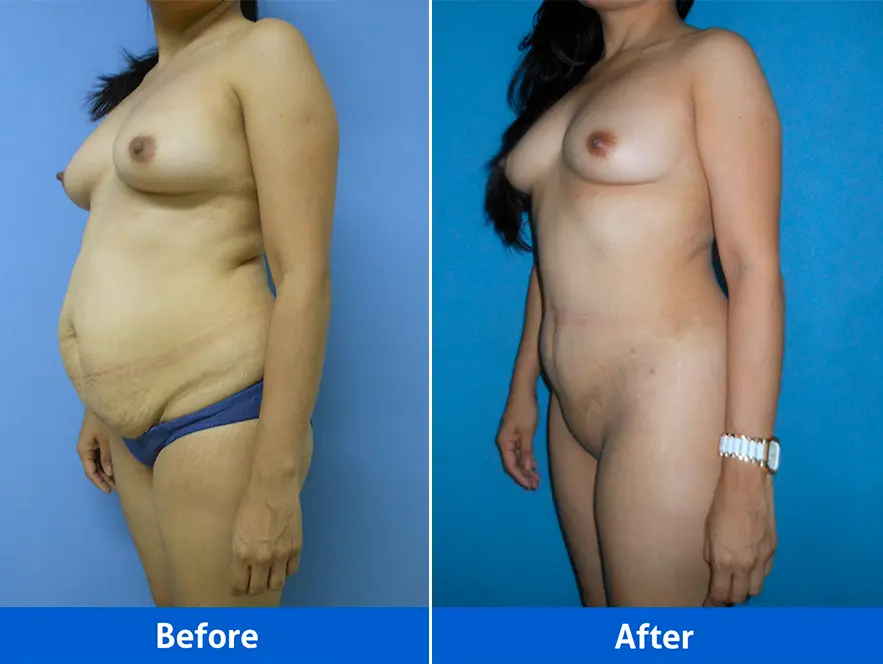 Rhinoplasty before after photos front view patient 2