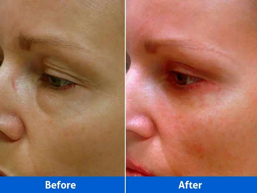 Blepharoplasty before after photos close view showing detailed eyelid surgery results