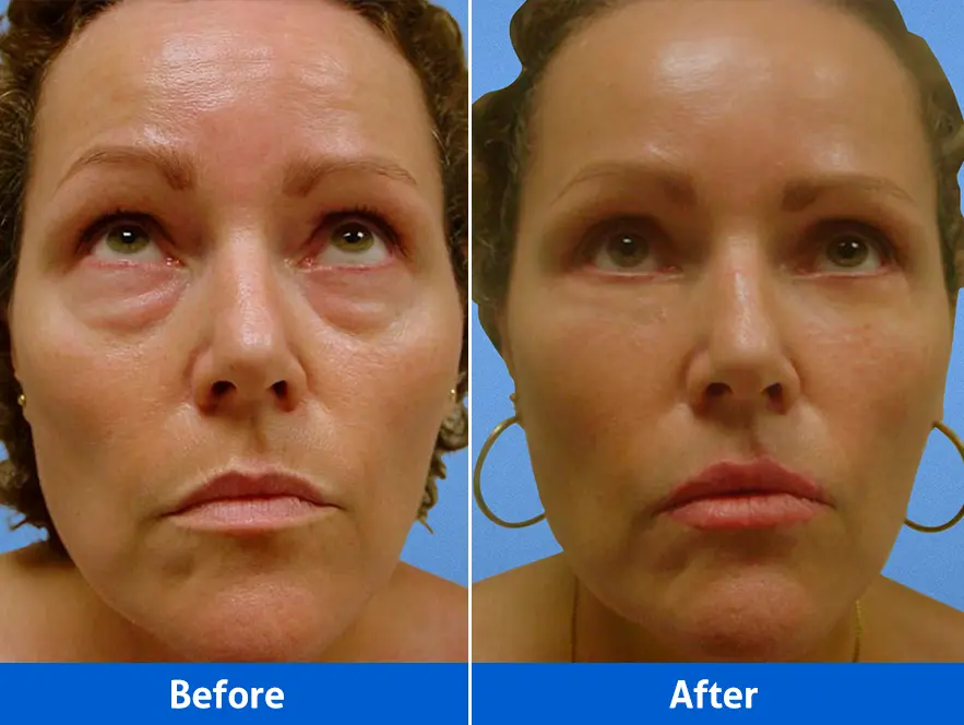 Blepharoplasty before and after in Cancún – Eyelid surgery, front view, looking up