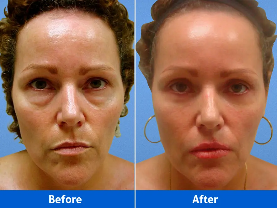 Blepharoplasty before after photos front view highlighting eye area transformation