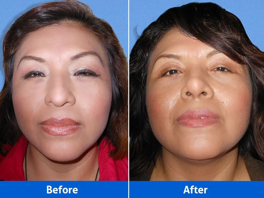 Blepharoplasty with rhinoplasty before after photos front view showing combined procedure results