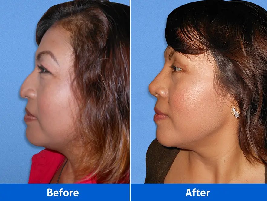 Blepharoplasty with rhinoplasty before after photos left profile highlighting facial balance improvement
