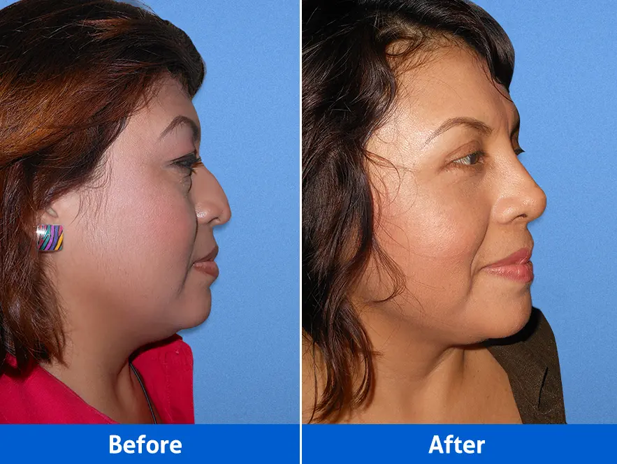 Blepharoplasty before and after in Cancún – Blepharoplasty + Rhinoplasty, right profile