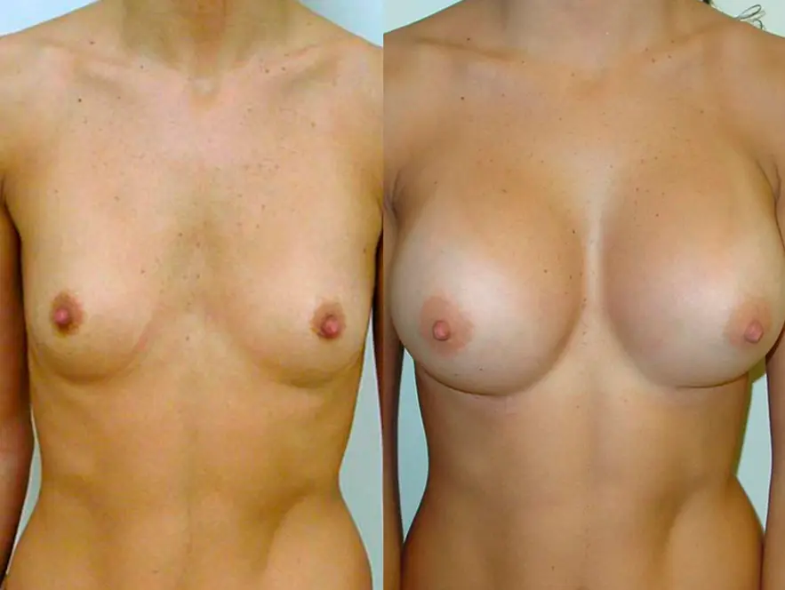 Breast Implants Before After Photos