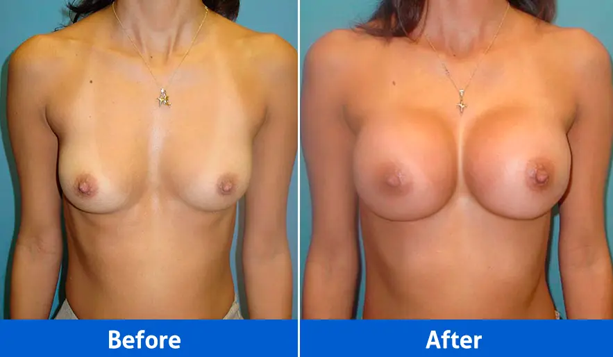 Breast implants before and after front view, Patient 1