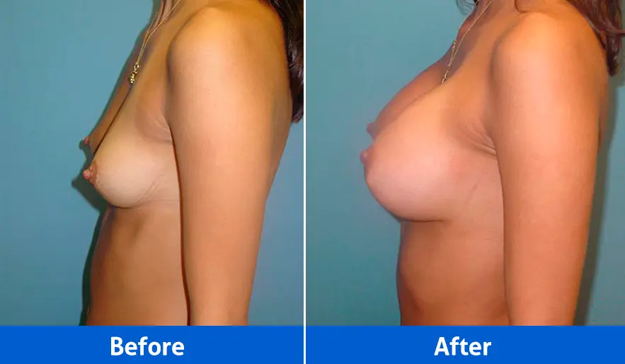 Breast Implants before and after in Cancún – Patient 1, left profile