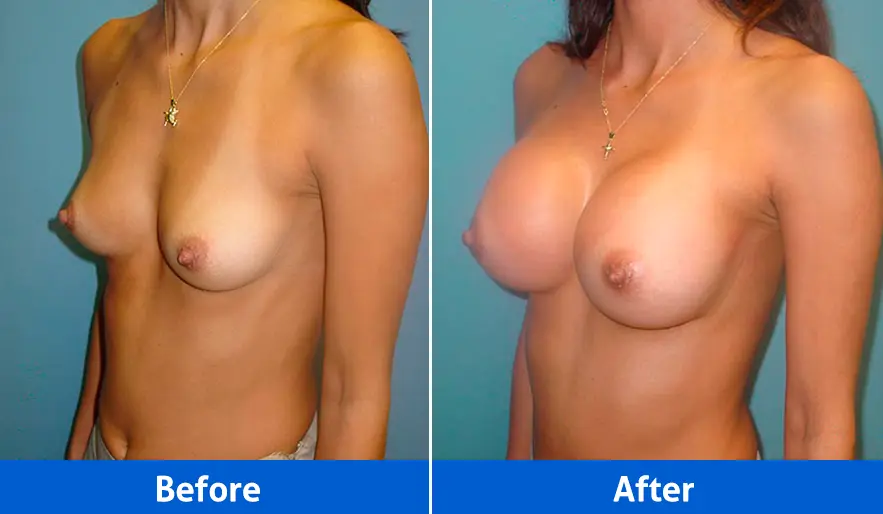 Breast Implants before and after in Cancún – Patient 1, left angled view