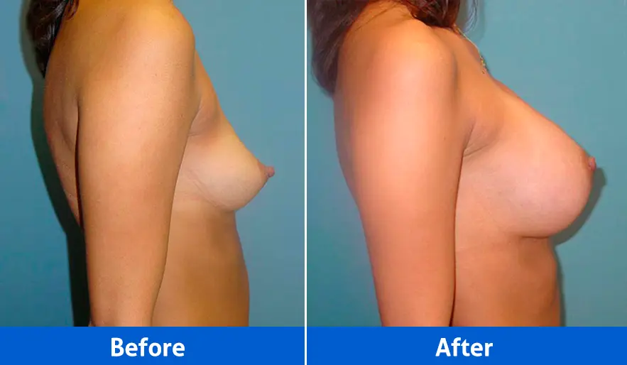 Breast Implants before and after in Cancún – Patient 1, right profile