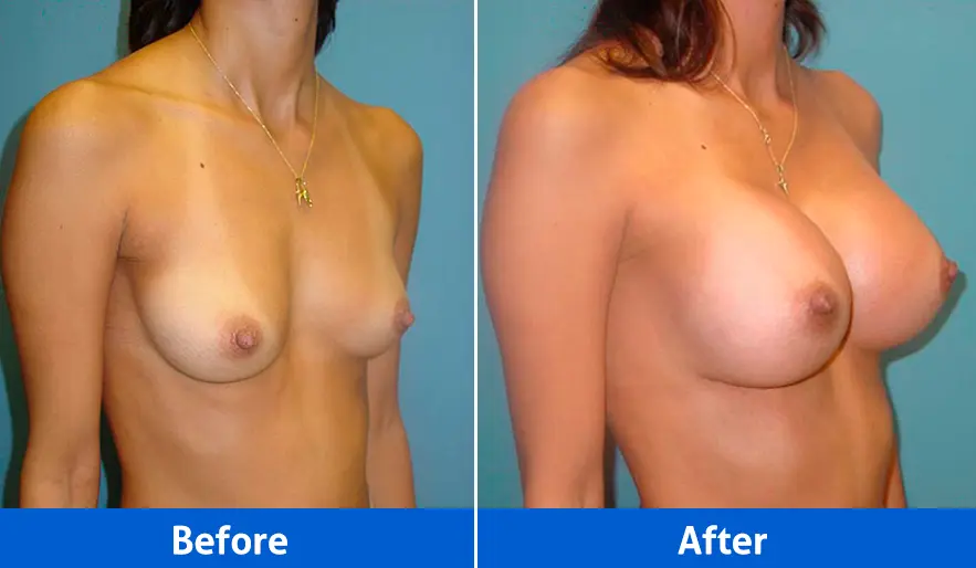 Breast Implants before and after in Cancún – Patient 1, right angled view