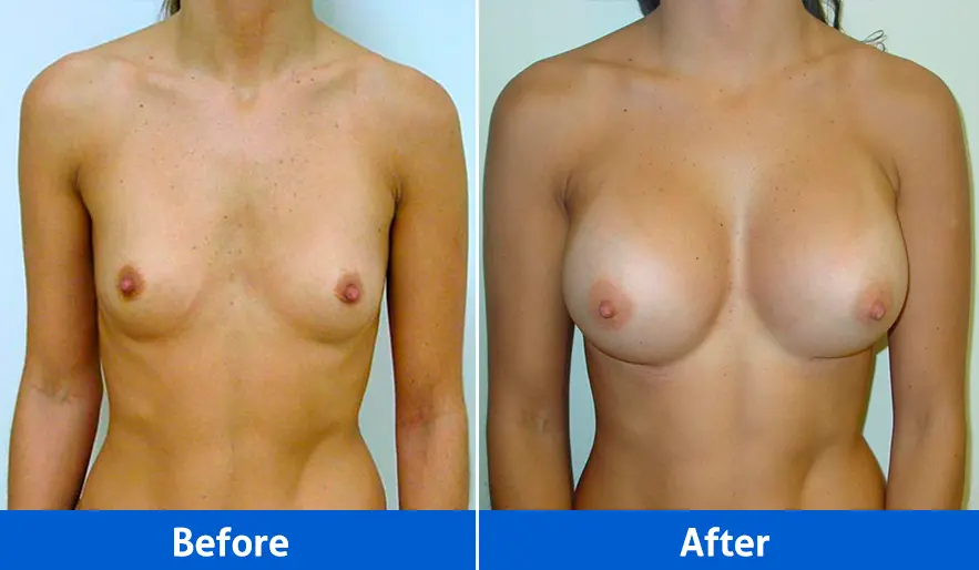 Breast implants before and after front view, Patient 2