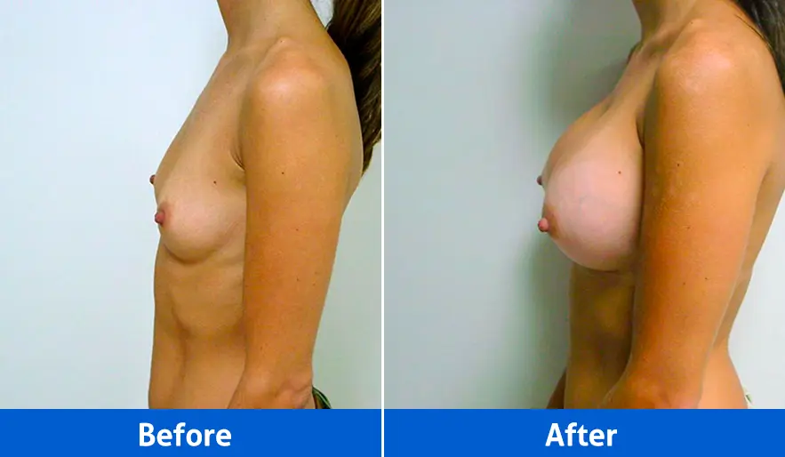 Breast Implants before and after in Cancún – Patient 2, left profile