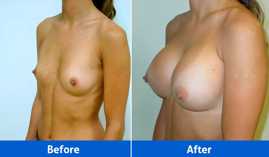 Breast Implants before and after in Cancún – Patient 2, left angled view