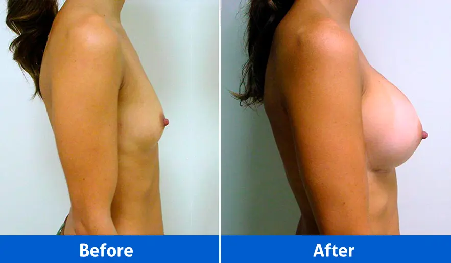 Breast Implants before and after in Cancún – Patient 2, right profile