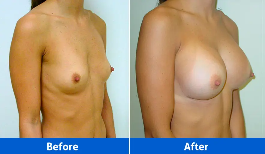Breast Implants before and after in Cancún – Patient 2, right angled view