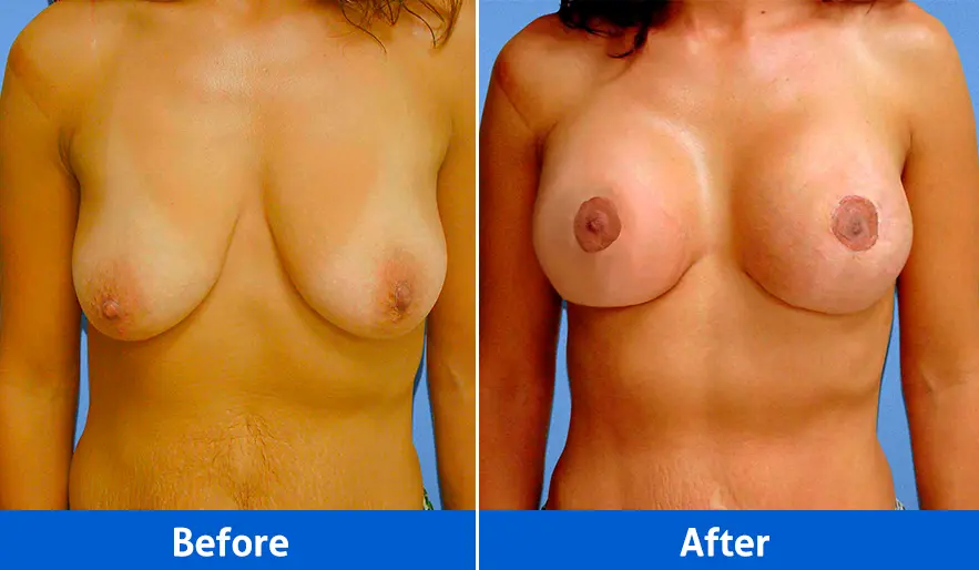 Breast implants before and after front view, Patient 4