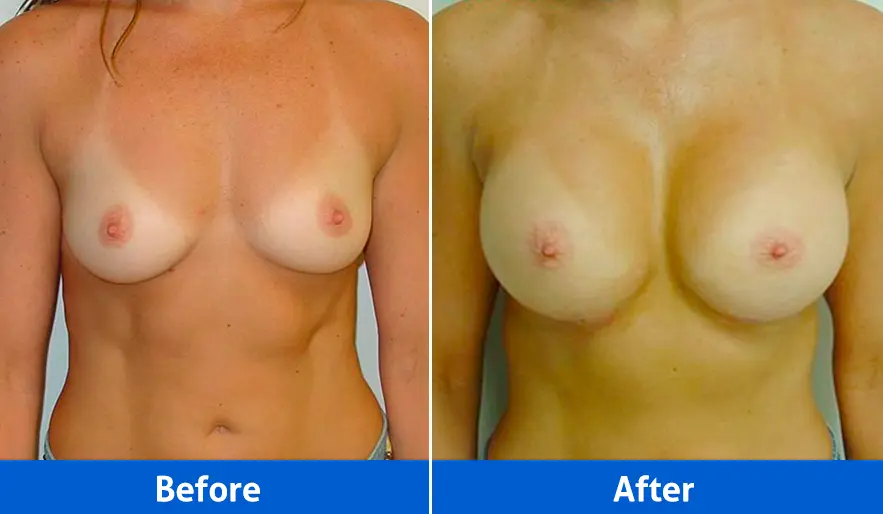 Breast implants before and after front view, Patient 3