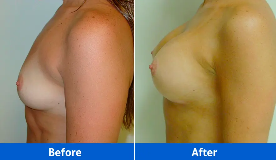 Breast Implants before and after in Cancún – Patient 3, left profile