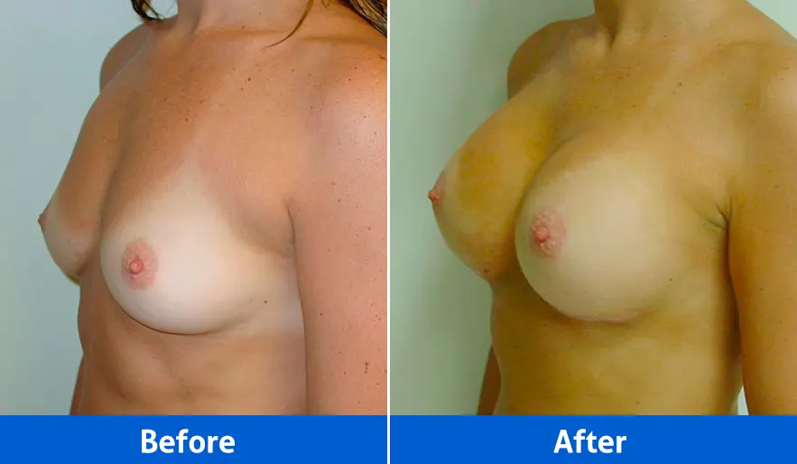 Breast Implants before and after in Cancún – Patient 3, left angled view