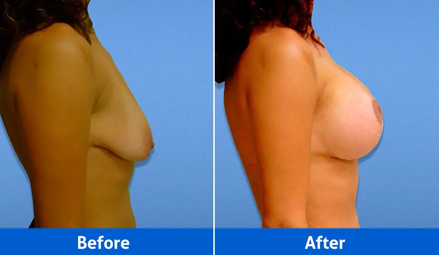 Breast Implants before and after in Cancún – Patient 4, right profile