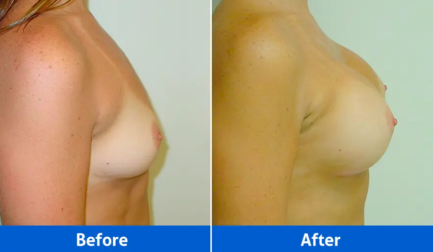 Breast Implants before and after in Cancún – Patient 3, right profile