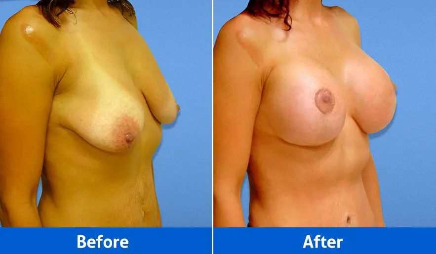 Breast Implants before and after in Cancún – Patient 4, right angled view