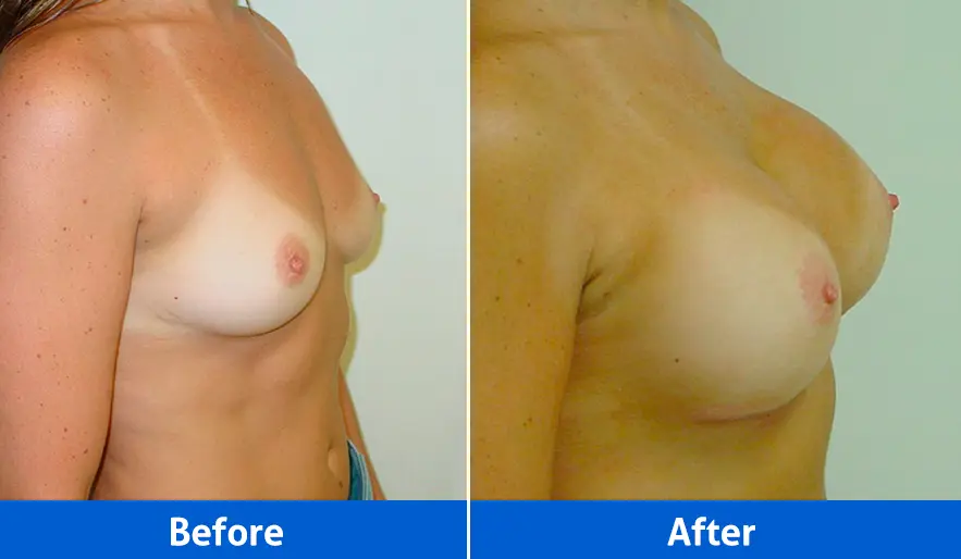 Breast Implants before and after in Cancún – Patient 3, right angled view