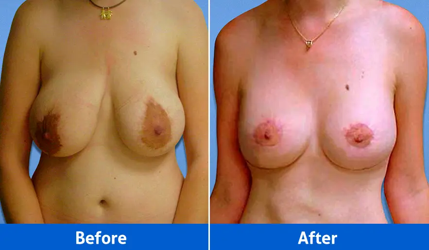 Breast lift front view results