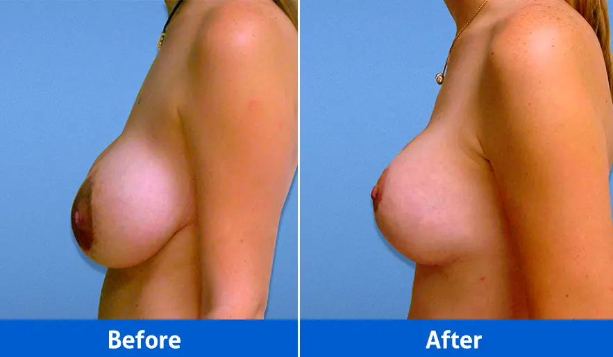Rhinoplasty before after photos front view patient 2