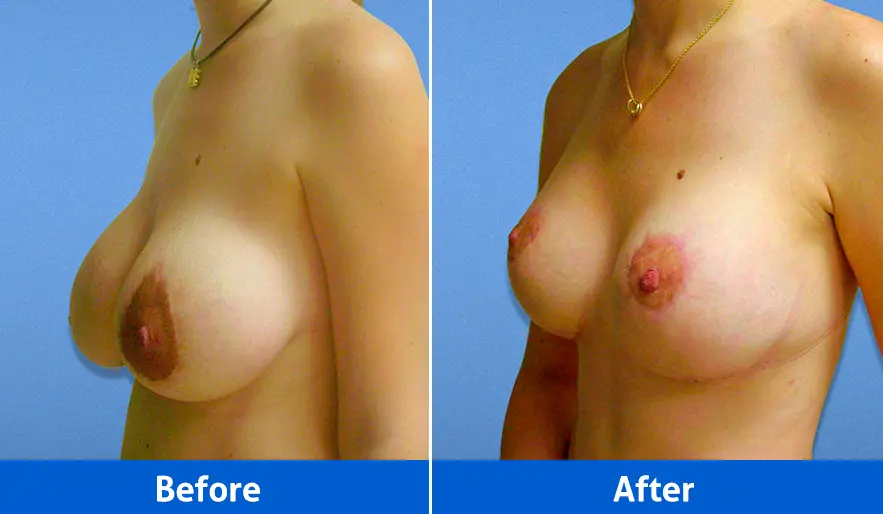 Rhinoplasty before and after front view, Patient 4