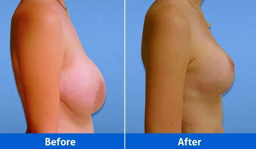 Breast lift left profile results