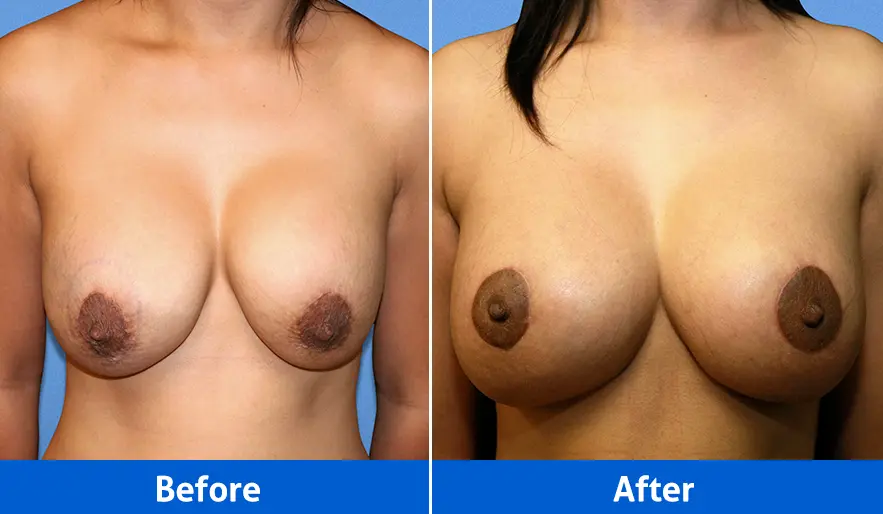Breast lift with implants before and after front view, Patient 5