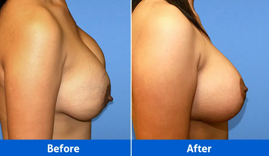 Breast Implants before and after in Cancún – Patient 5 – Lift with implants, right profile