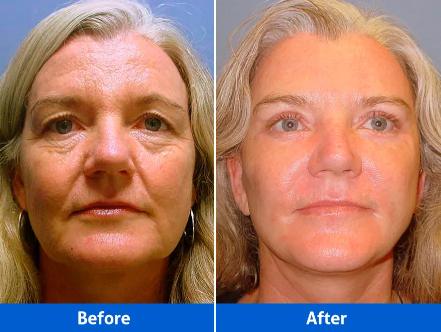 Before and after deep plane facelift in Cancun by Dr. Rafael Velasco Marín demonstrating jowl correction and neck rejuvenation