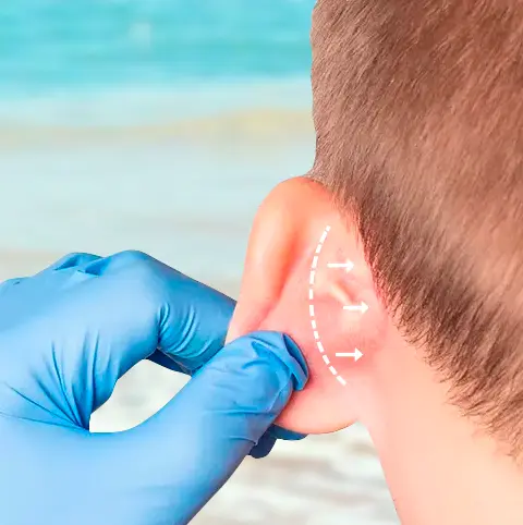 Otoplasty Surgery Cancun