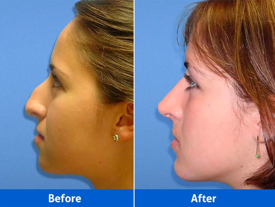 Rhinoplasty before and after — Patient 2 left profile showing enhanced bridge line and refined tip projection