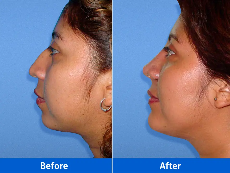 Rhinoplasty before and after — Patient 3 left profile showing precision structural correction of the nasal anatomy