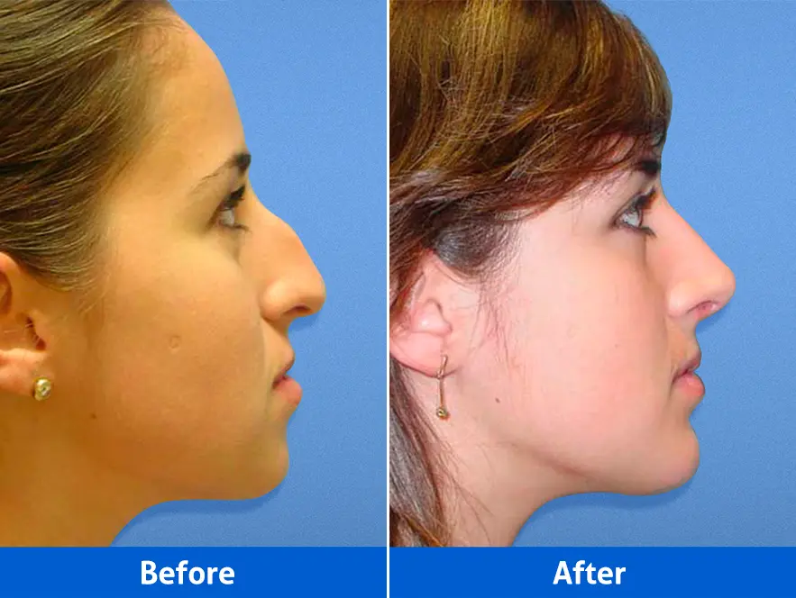 Before and after open rhinoplasty in Cancun by Dr. Rafael Velasco Marín, showing dorsal hump reduction and nasal tip refinement