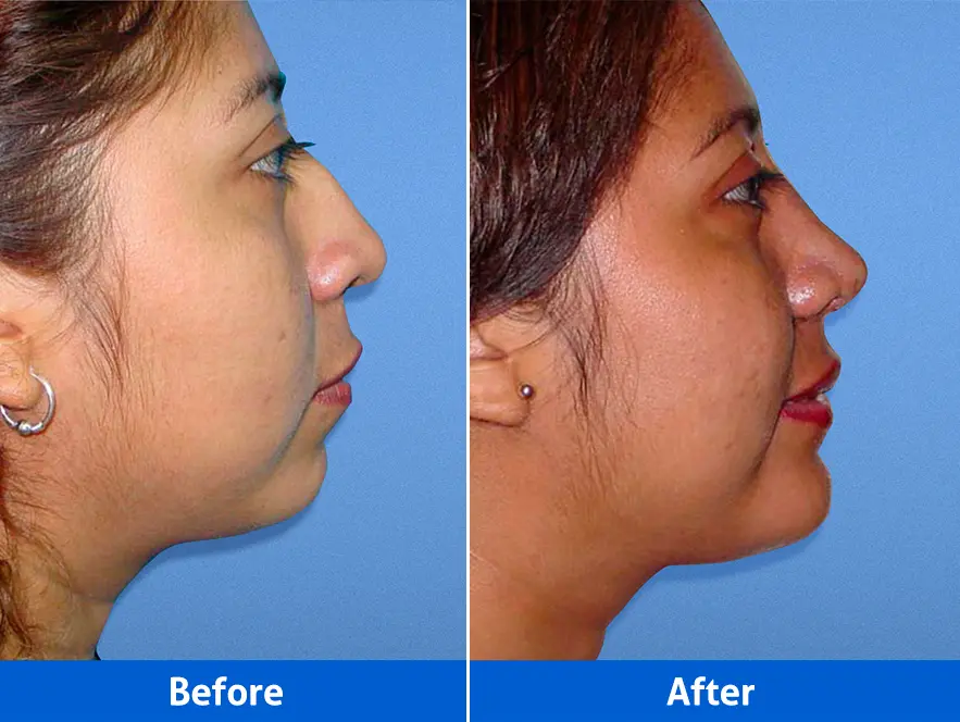 Rhinoplasty before after photos right profile patient 3 showing improved nasal proportions