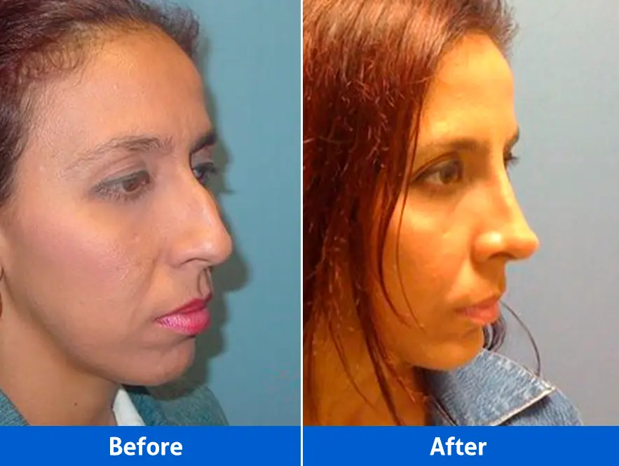 Rhinoplasty before and after — Patient 4 right profile demonstrating a significant yet natural-looking nasal transformation