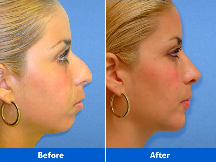 Rhinoplasty before and after — Patient 1 right profile showing natural symmetry contours post surgery