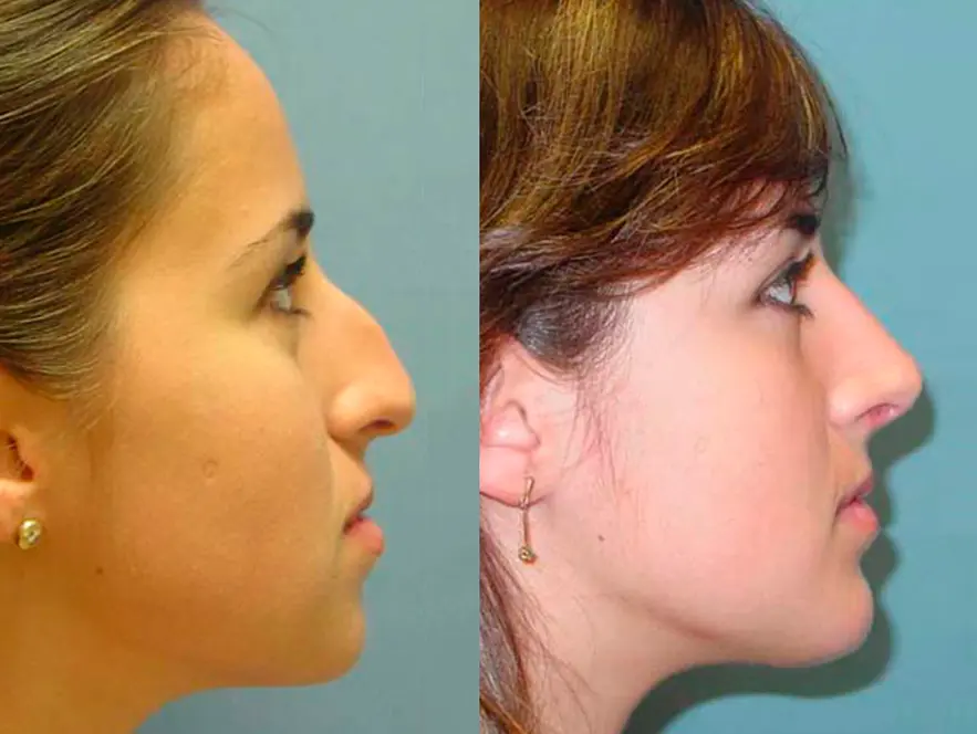 Rhinoplasty Before After Photos