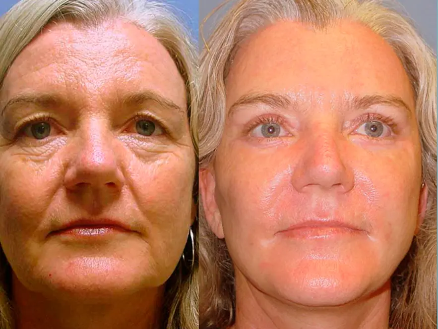 Facelift Before After Photos