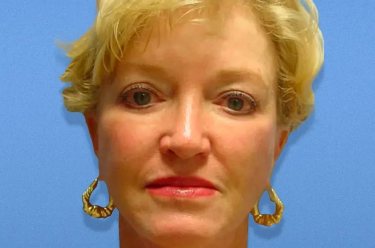 Facelift Cancun results patient 1 – front view after rhytidectomy