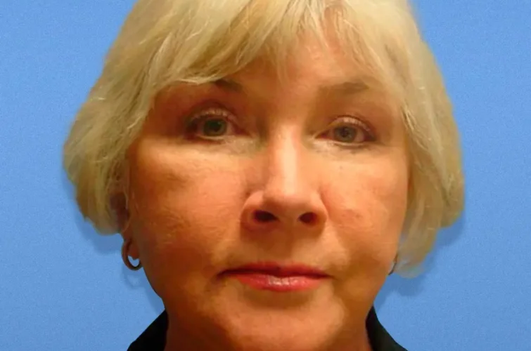 Patient 2 after facelift in Cancun – front-facing rhytidectomy photo