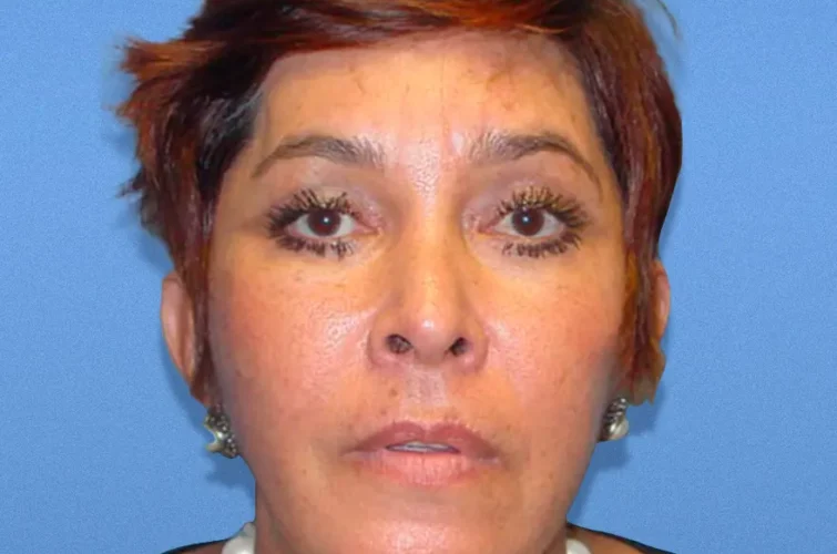 Facelift in Cancun after surgery – patient 3 front view