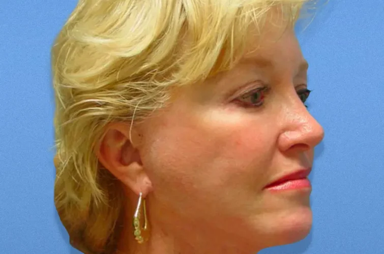 Facelift Cancun – Patient 1 post-op front and profile view
