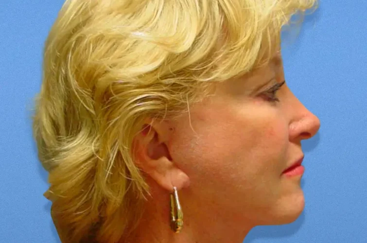 Side profile of facelift results in Cancun – patient 1