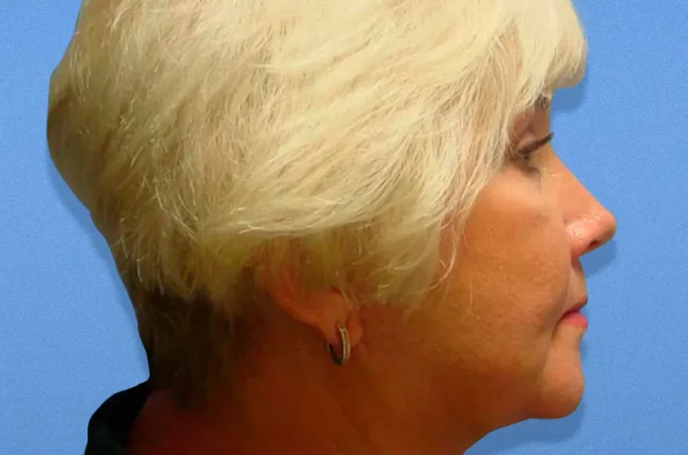 After facelift profile photo – Cancun rhytidectomy patient 2
